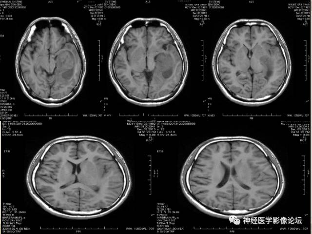 【病例】非婴儿型促纤维生成型节细胞胶质瘤一例