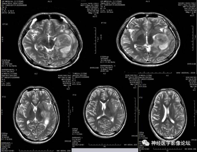 【病例】非婴儿型促纤维生成型节细胞胶质瘤一例
