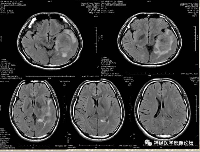 【病例】非婴儿型促纤维生成型节细胞胶质瘤一例