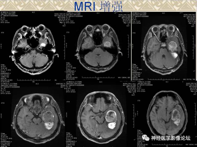 【病例】非婴儿型促纤维生成型节细胞胶质瘤一例