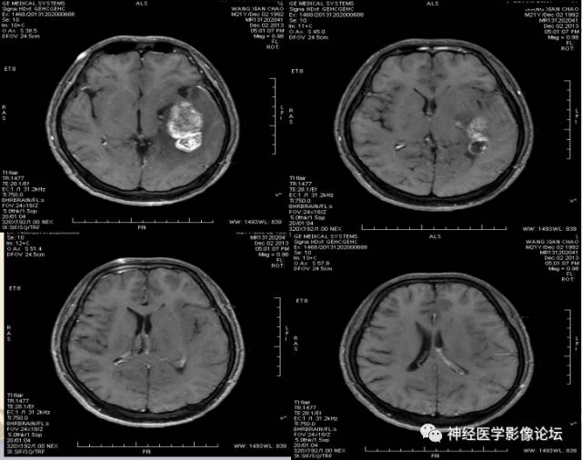 【病例】非婴儿型促纤维生成型节细胞胶质瘤一例