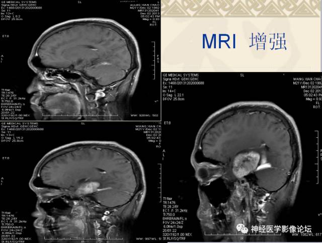 【病例】非婴儿型促纤维生成型节细胞胶质瘤一例