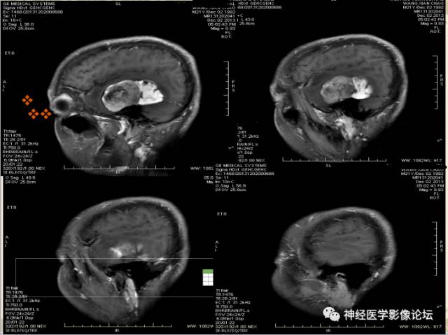 【病例】非婴儿型促纤维生成型节细胞胶质瘤一例