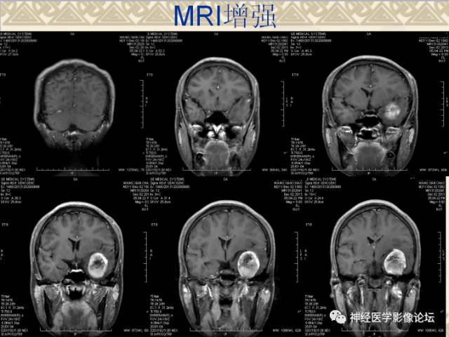 【病例】非婴儿型促纤维生成型节细胞胶质瘤一例