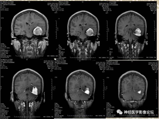 【病例】非婴儿型促纤维生成型节细胞胶质瘤一例
