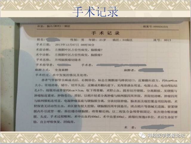 【病例】非婴儿型促纤维生成型节细胞胶质瘤一例