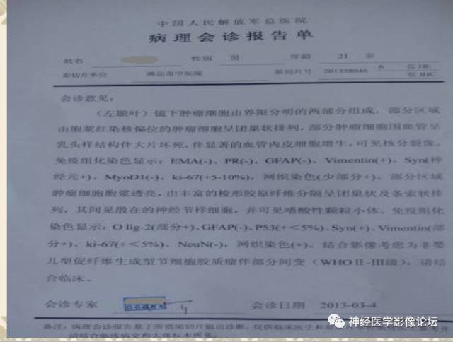 【病例】非婴儿型促纤维生成型节细胞胶质瘤一例