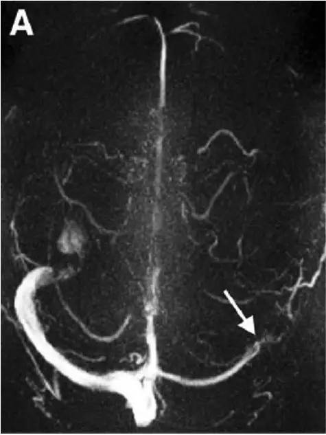 Neurosurgery:颅内压相关影像学表现之高颅压篇 Neurosurgery:颅内压相关影像学表现之高颅压篇