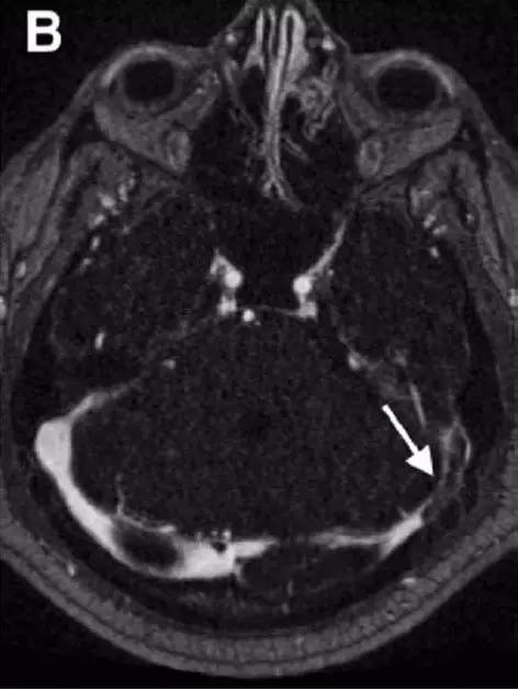Neurosurgery:颅内压相关影像学表现之高颅压篇 Neurosurgery:颅内压相关影像学表现之高颅压篇