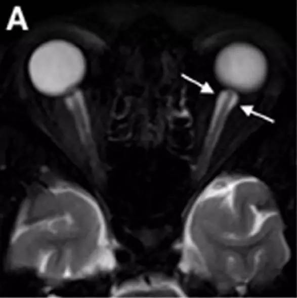 Neurosurgery:颅内压相关影像学表现之高颅压篇 Neurosurgery:颅内压相关影像学表现之高颅压篇