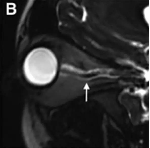 Neurosurgery：颅内压相关影像学表现之高颅压篇