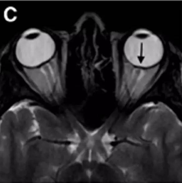 Neurosurgery:颅内压相关影像学表现之高颅压篇 Neurosurgery:颅内压相关影像学表现之高颅压篇