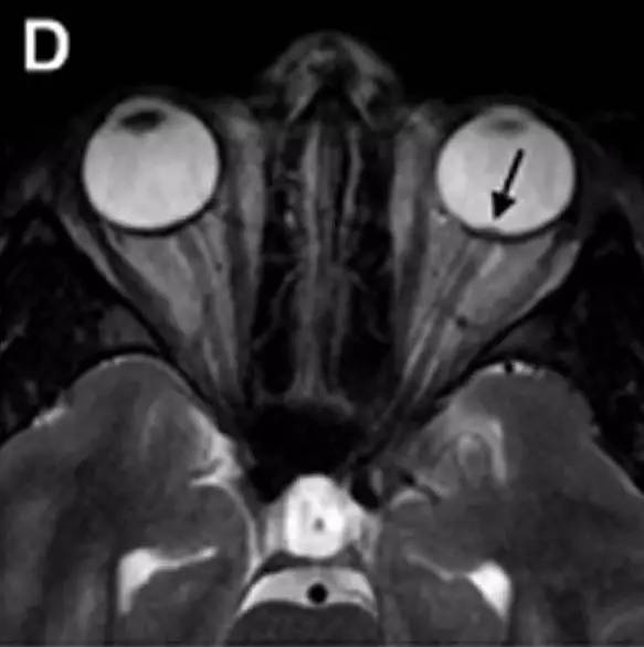 Neurosurgery:颅内压相关影像学表现之高颅压篇 Neurosurgery:颅内压相关影像学表现之高颅压篇
