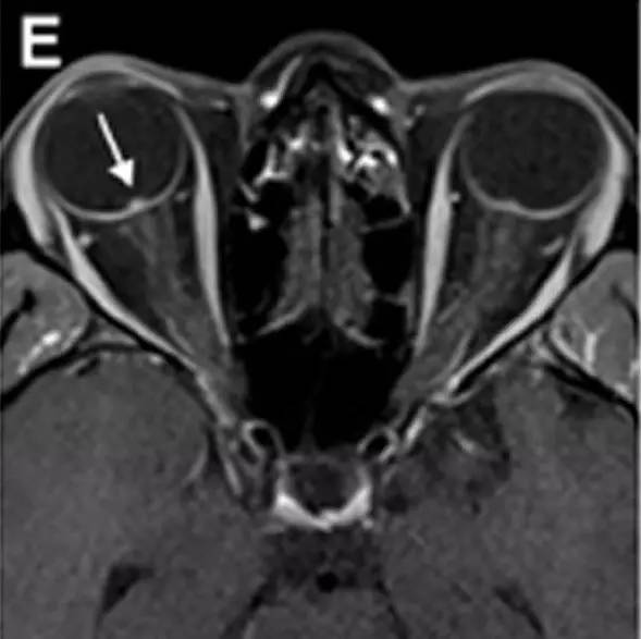 Neurosurgery:颅内压相关影像学表现之高颅压篇 Neurosurgery:颅内压相关影像学表现之高颅压篇