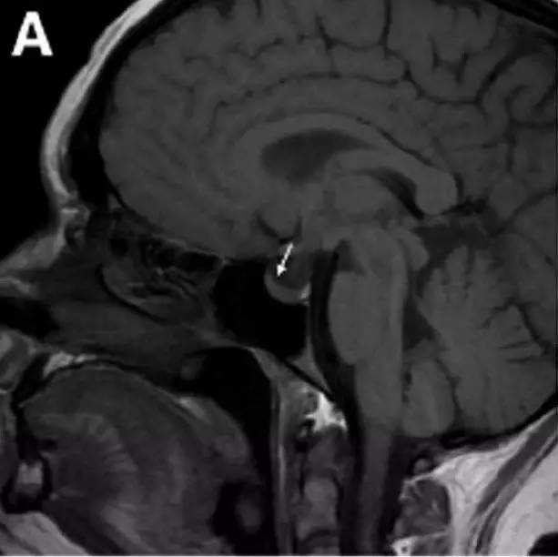 Neurosurgery:颅内压相关影像学表现之高颅压篇 Neurosurgery:颅内压相关影像学表现之高颅压篇