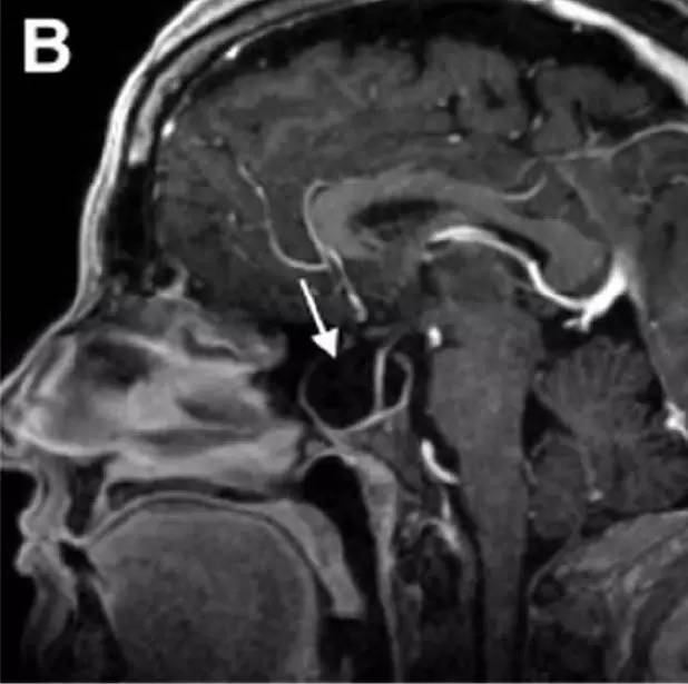 Neurosurgery:颅内压相关影像学表现之高颅压篇 Neurosurgery:颅内压相关影像学表现之高颅压篇