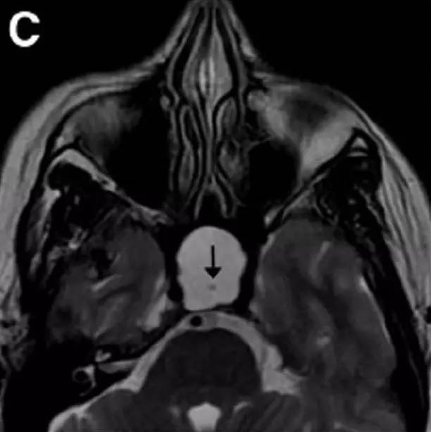 Neurosurgery:颅内压相关影像学表现之高颅压篇 Neurosurgery:颅内压相关影像学表现之高颅压篇