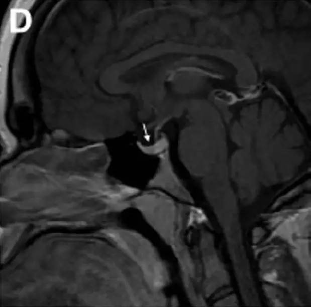 Neurosurgery:颅内压相关影像学表现之高颅压篇 Neurosurgery:颅内压相关影像学表现之高颅压篇