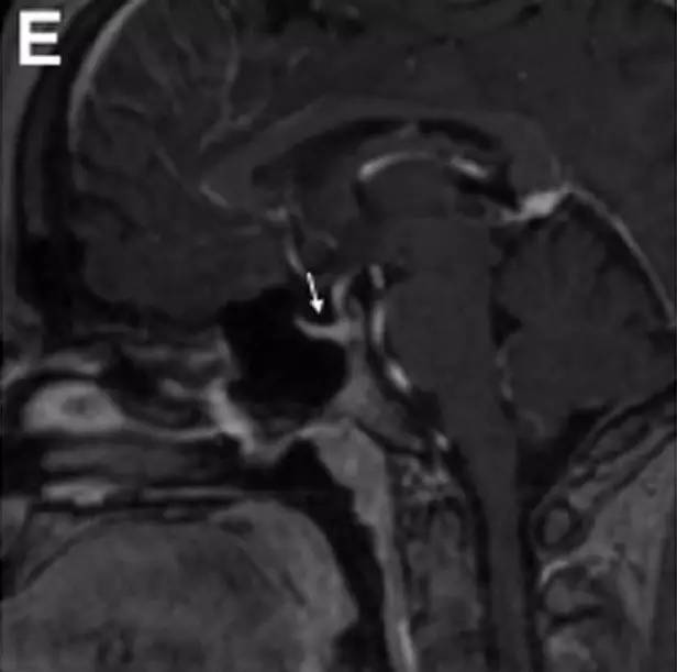 Neurosurgery:颅内压相关影像学表现之高颅压篇 Neurosurgery:颅内压相关影像学表现之高颅压篇