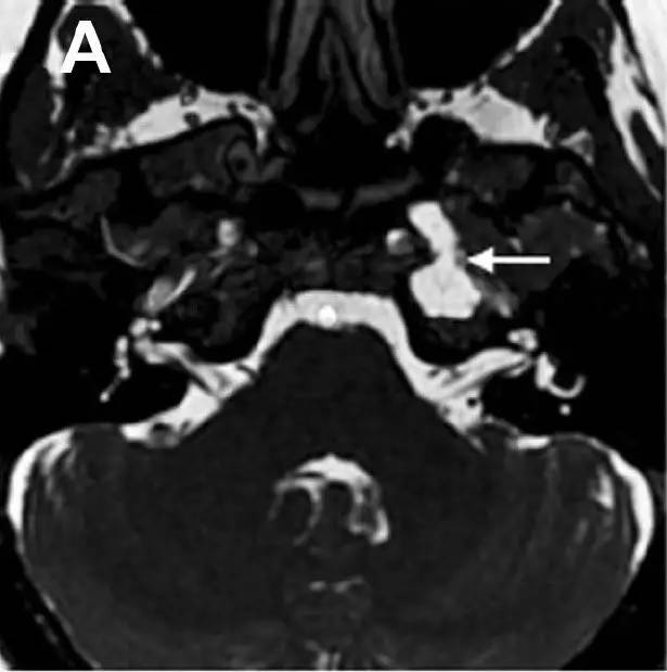 Neurosurgery:颅内压相关影像学表现之高颅压篇 Neurosurgery:颅内压相关影像学表现之高颅压篇