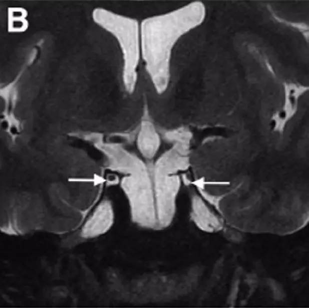 Neurosurgery:颅内压相关影像学表现之高颅压篇 Neurosurgery:颅内压相关影像学表现之高颅压篇