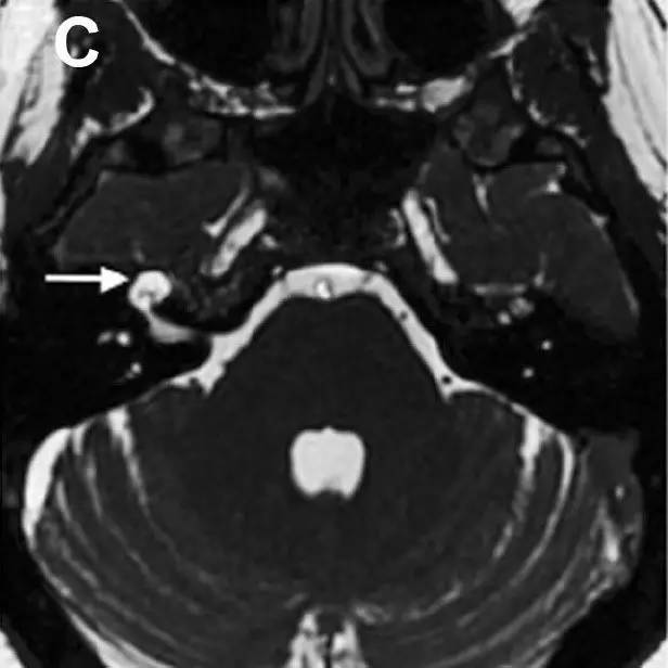 Neurosurgery:颅内压相关影像学表现之高颅压篇 Neurosurgery:颅内压相关影像学表现之高颅压篇