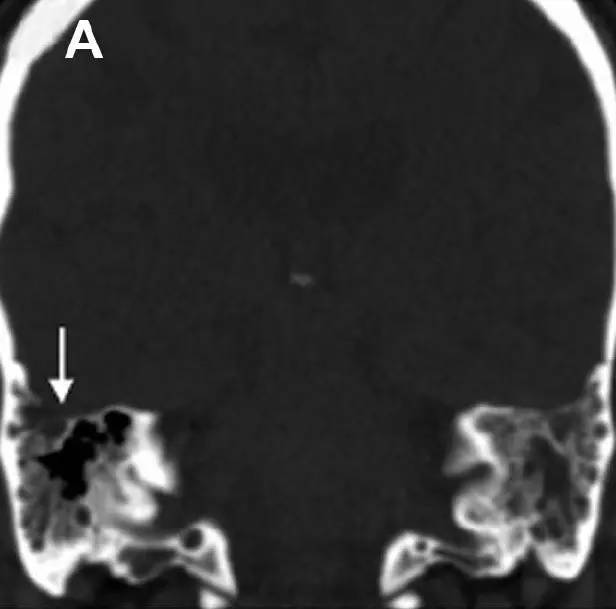 Neurosurgery:颅内压相关影像学表现之高颅压篇 Neurosurgery:颅内压相关影像学表现之高颅压篇