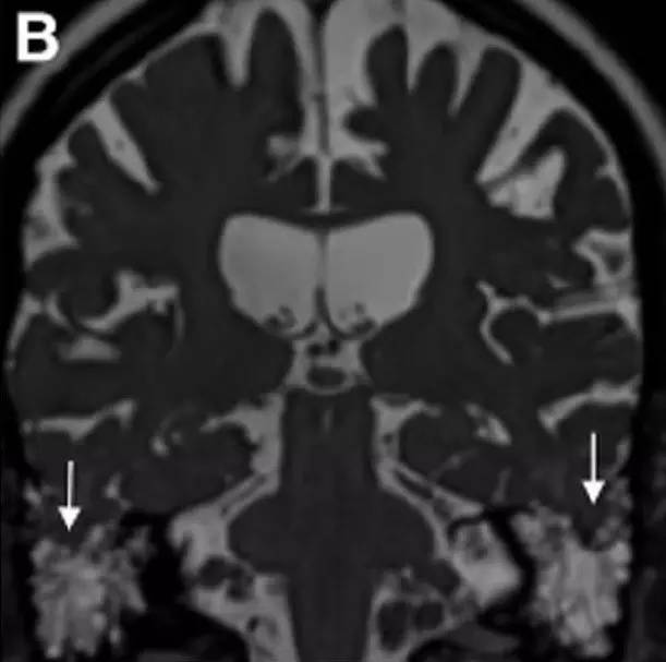 Neurosurgery:颅内压相关影像学表现之高颅压篇 Neurosurgery:颅内压相关影像学表现之高颅压篇