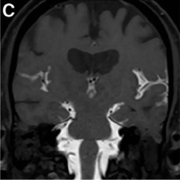 Neurosurgery:颅内压相关影像学表现之高颅压篇 Neurosurgery:颅内压相关影像学表现之高颅压篇