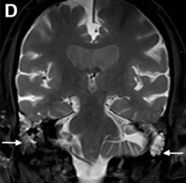 Neurosurgery:颅内压相关影像学表现之高颅压篇 Neurosurgery:颅内压相关影像学表现之高颅压篇