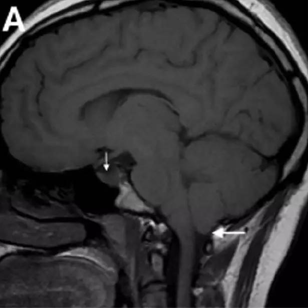 Neurosurgery:颅内压相关影像学表现之高颅压篇 Neurosurgery:颅内压相关影像学表现之高颅压篇