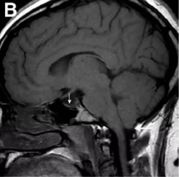 Neurosurgery:颅内压相关影像学表现之高颅压篇 Neurosurgery:颅内压相关影像学表现之高颅压篇