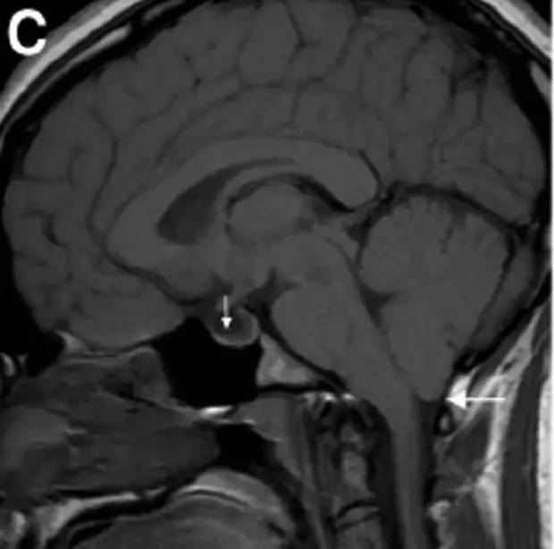Neurosurgery:颅内压相关影像学表现之高颅压篇 Neurosurgery:颅内压相关影像学表现之高颅压篇