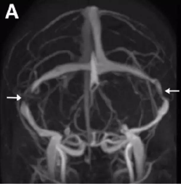 Neurosurgery:颅内压相关影像学表现之高颅压篇 Neurosurgery:颅内压相关影像学表现之高颅压篇