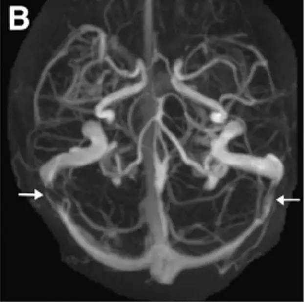 Neurosurgery:颅内压相关影像学表现之高颅压篇 Neurosurgery:颅内压相关影像学表现之高颅压篇