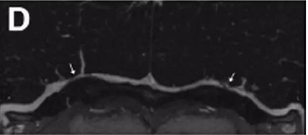 Neurosurgery:颅内压相关影像学表现之高颅压篇 Neurosurgery:颅内压相关影像学表现之高颅压篇