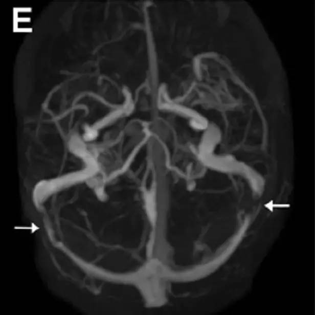 Neurosurgery:颅内压相关影像学表现之高颅压篇 Neurosurgery:颅内压相关影像学表现之高颅压篇