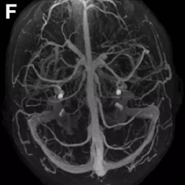 Neurosurgery:颅内压相关影像学表现之高颅压篇 Neurosurgery:颅内压相关影像学表现之高颅压篇
