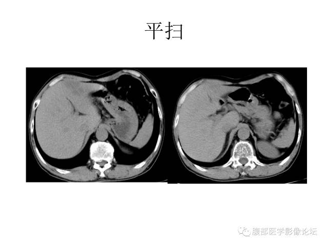 【病例】肝胆管细胞癌误诊成脓肿一例CT 【病例】肝胆管细胞癌误诊成脓肿一例CT