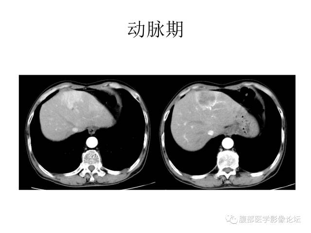 【病例】肝胆管细胞癌误诊成脓肿一例CT 【病例】肝胆管细胞癌误诊成脓肿一例CT