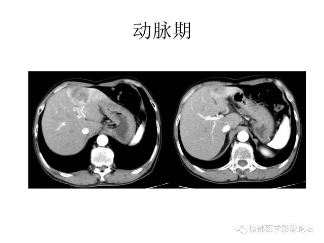 【病例】肝胆管细胞癌误诊成脓肿一例CT 【病例】肝胆管细胞癌误诊成脓肿一例CT