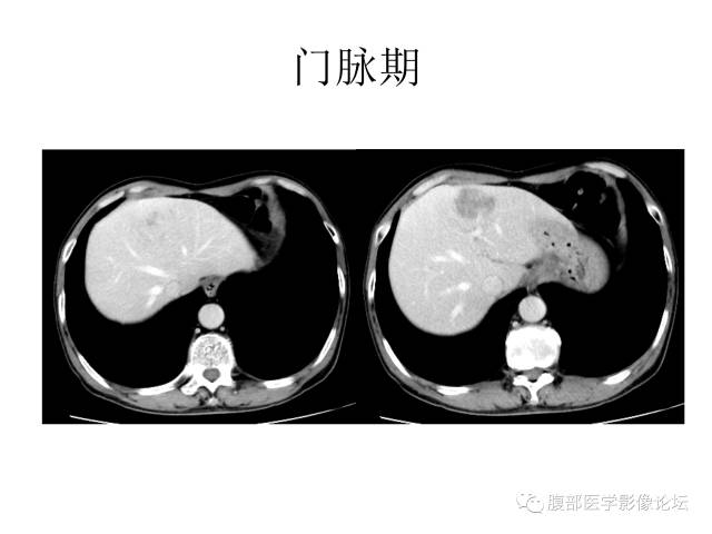 【病例】肝胆管细胞癌误诊成脓肿一例CT 【病例】肝胆管细胞癌误诊成脓肿一例CT
