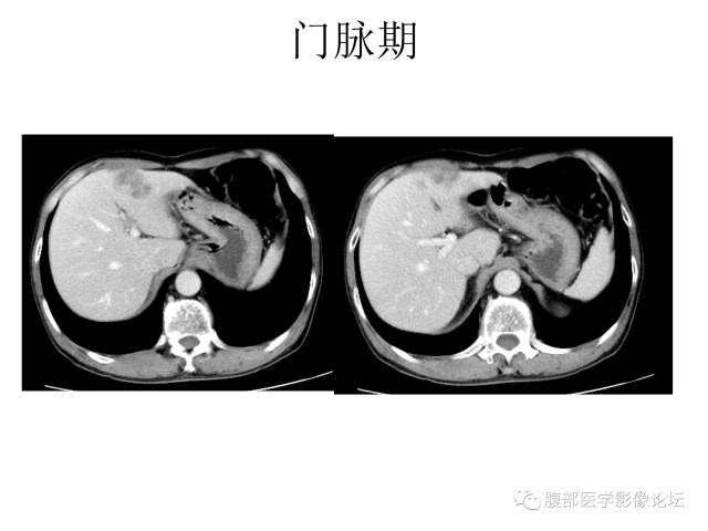 【病例】肝胆管细胞癌误诊成脓肿一例CT 【病例】肝胆管细胞癌误诊成脓肿一例CT