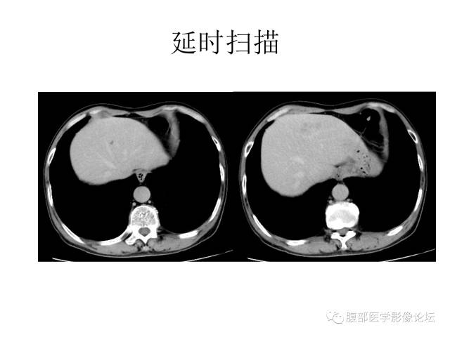 【病例】肝胆管细胞癌误诊成脓肿一例CT 【病例】肝胆管细胞癌误诊成脓肿一例CT