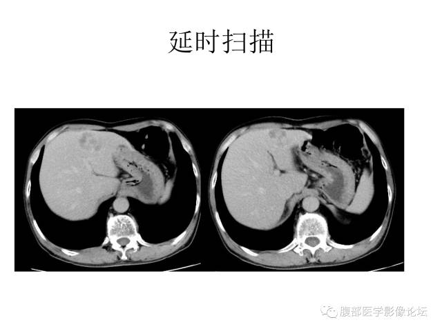 【病例】肝胆管细胞癌误诊成脓肿一例CT 【病例】肝胆管细胞癌误诊成脓肿一例CT