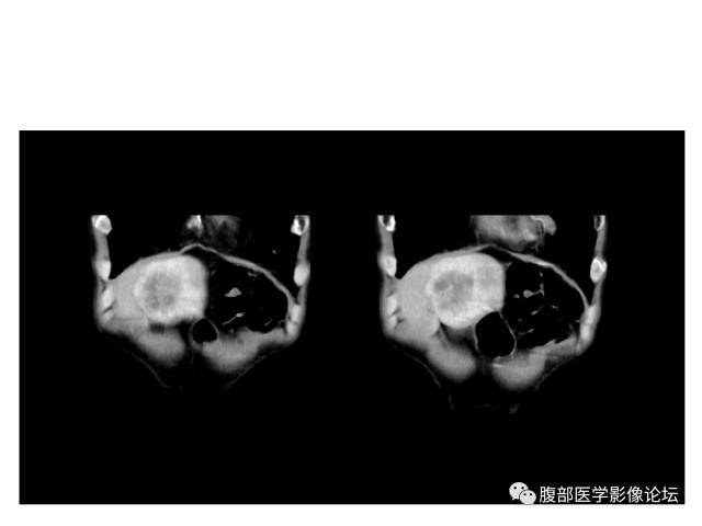 【病例】肝胆管细胞癌误诊成脓肿一例CT 【病例】肝胆管细胞癌误诊成脓肿一例CT