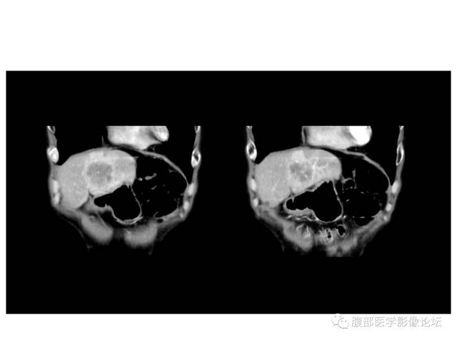【病例】肝胆管细胞癌误诊成脓肿一例CT 【病例】肝胆管细胞癌误诊成脓肿一例CT