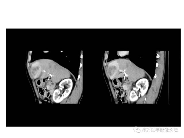 【病例】肝胆管细胞癌误诊成脓肿一例CT 【病例】肝胆管细胞癌误诊成脓肿一例CT