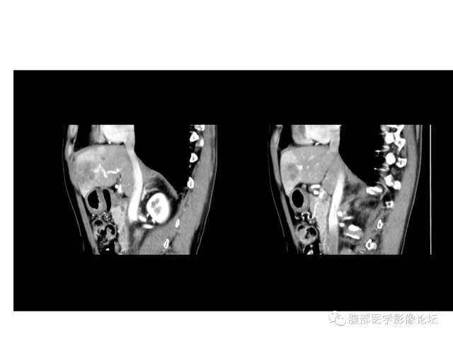 【病例】肝胆管细胞癌误诊成脓肿一例CT 【病例】肝胆管细胞癌误诊成脓肿一例CT