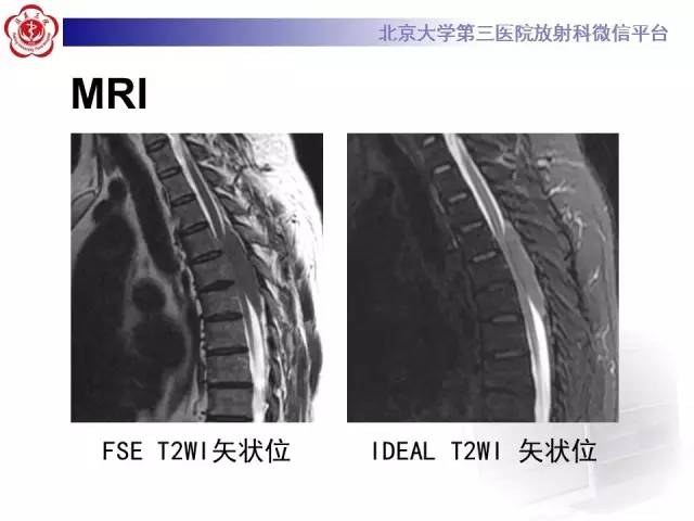 【病例】脊柱原发性硬膜外淋巴瘤1例MR